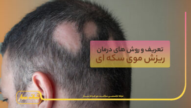 ریزش موی سکه ای