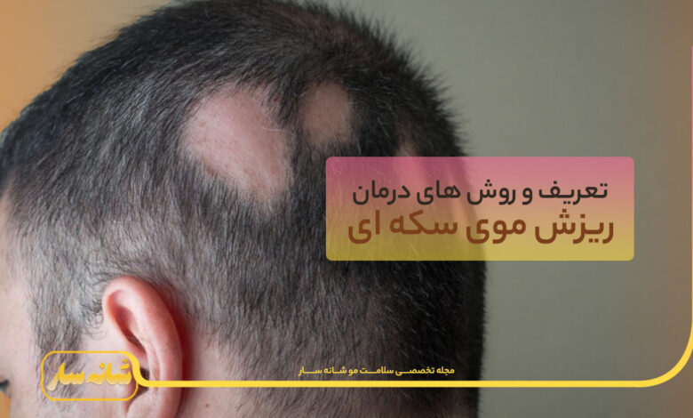 ریزش موی سکه ای