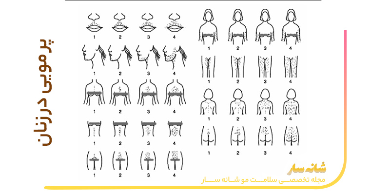 هیرسوتیسم