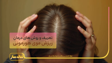 ریزش موی هورمونی