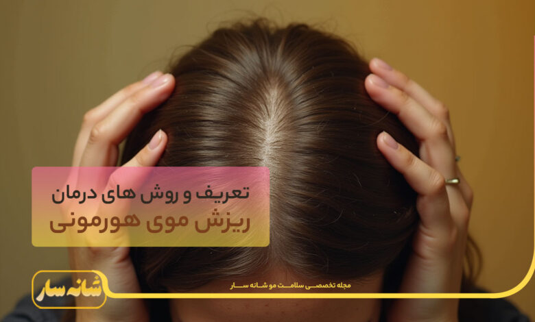ریزش موی هورمونی