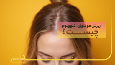 ریزش موی تلوژن افلوویوم