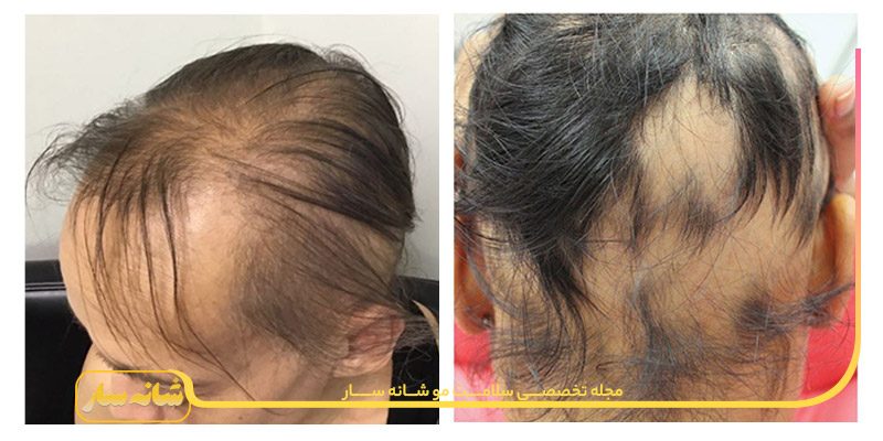 ریزش مو آناژن افلوویوم