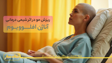 ریزش مو آناژن افلوویوم