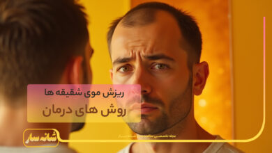 ریزش موی شقیقه