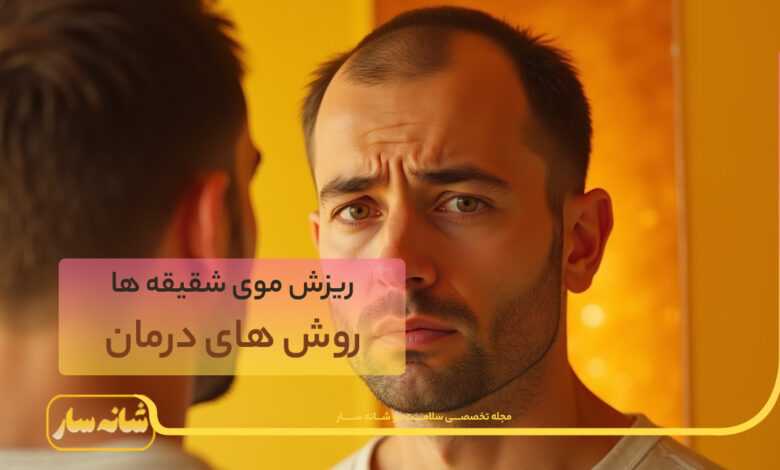 ریزش موی شقیقه