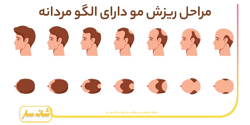 ریزش مو در مردان