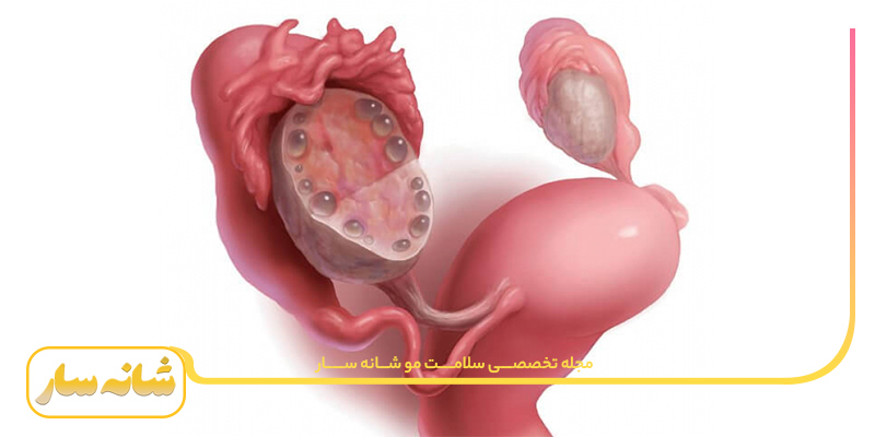 سندروم تخمدان پلی کیستیک