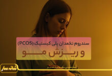 ریزش مو ناشی از سندروم تخمدان پلی کیستیک