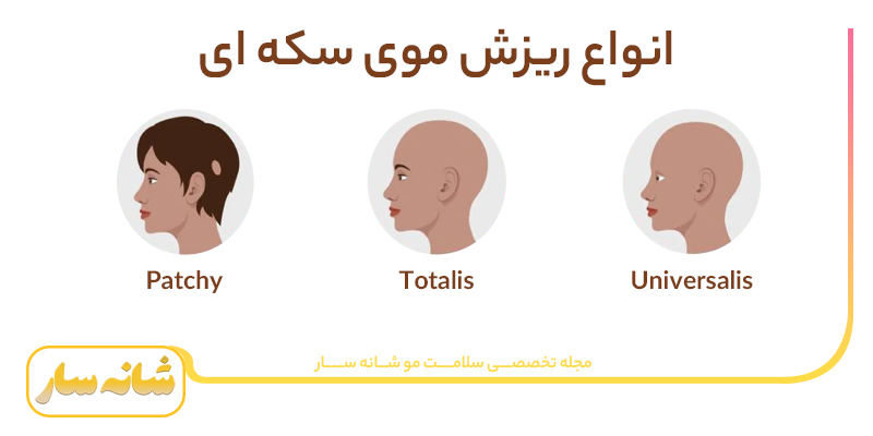 انواع ریزش موی سکه ای