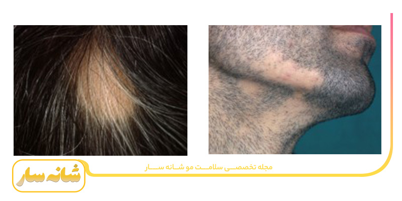ریزش موی سکه ای