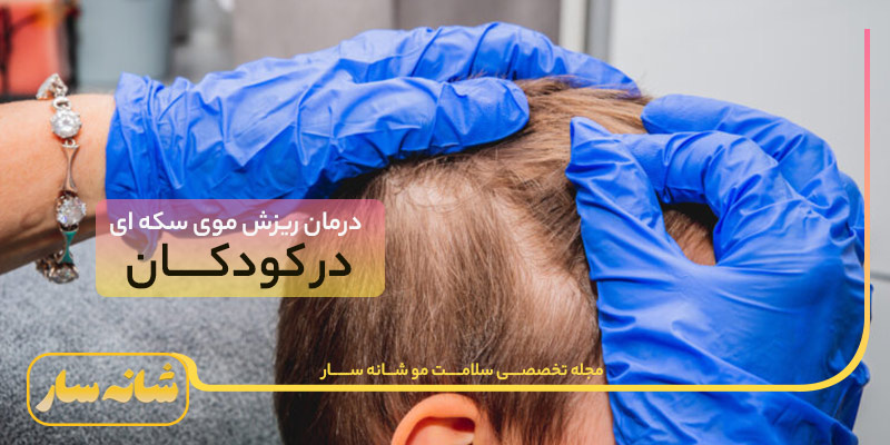 ریزش موی سکه ای در کودکان