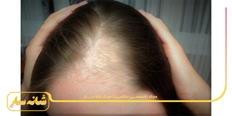 ریزش مو و PCOS